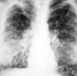 Fibroza pulmonara idiopatica difuza